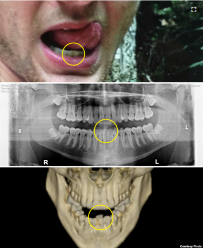VOAが公開した、ワームビアさんの歯列の変化を示す写真